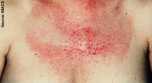 Osip na koži nastao usled fotoalergijske erupcije